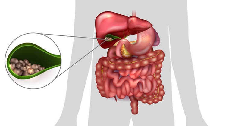 Colelitiasis (Piedras en la Vesícula Biliar)