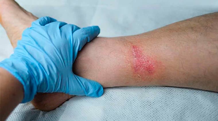 Heridas Crónicas
