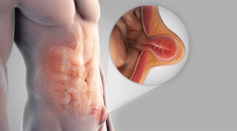 Hernia Inguinal
