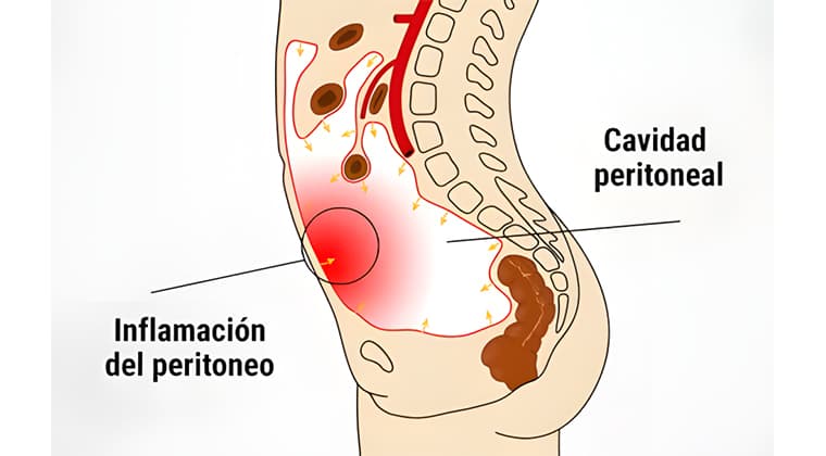 Peritonitis