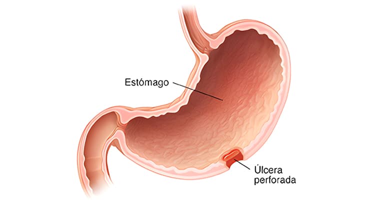 Úlcera Gástrica Perforada