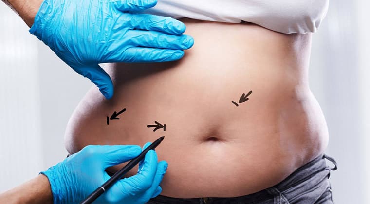Cirugía de Apendicitis (Apendicectomía)