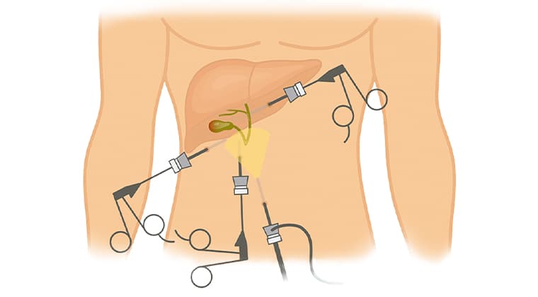 Cirugía de Vesícula Biliar (Colecistectomía)
