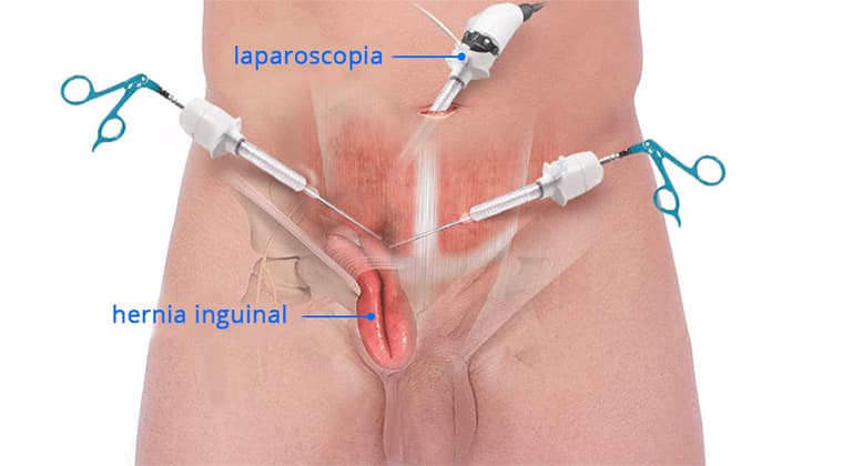 Reparación de Hernias (Inguinal, Umbilical, etc.)