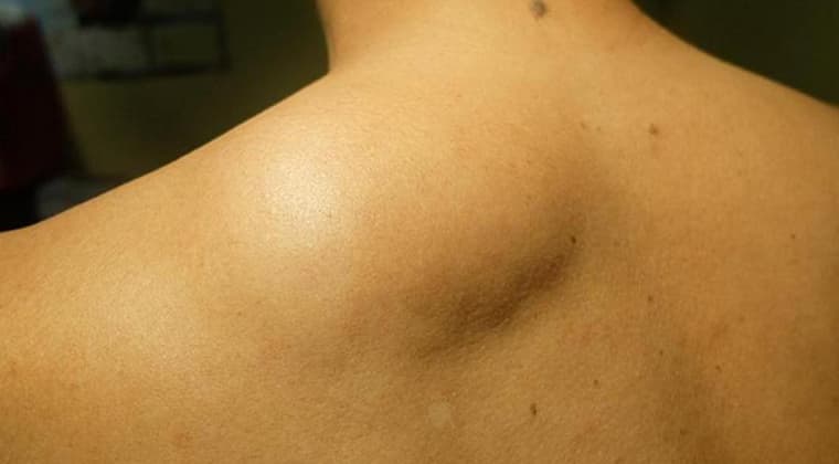 Masa o Bulto en Alguna Parte del Cuerpo